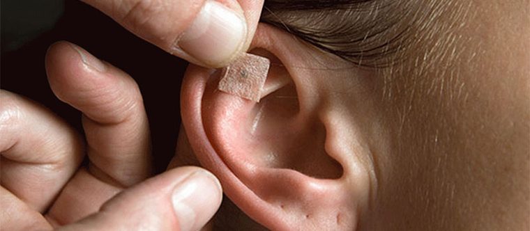 Aplicação de semente de auriculoterapia na orelha